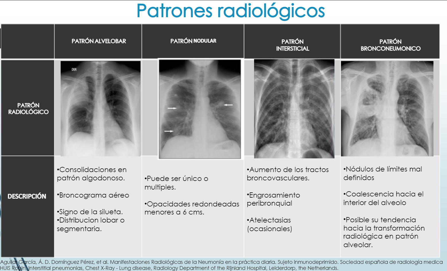Radiografía de tórax → 
La radiografía de tórax, preferentemente ántero-posterior y lateral tiene utilidad como apoyo diagnós