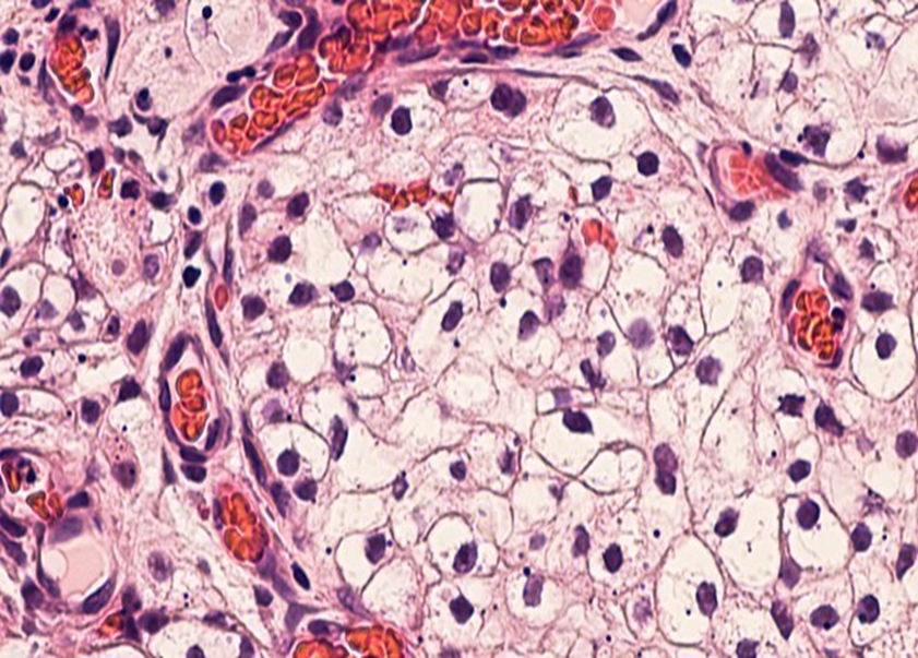 vasculatura ramificada delicada quer rodean los tumores DIAGNÓSTICO