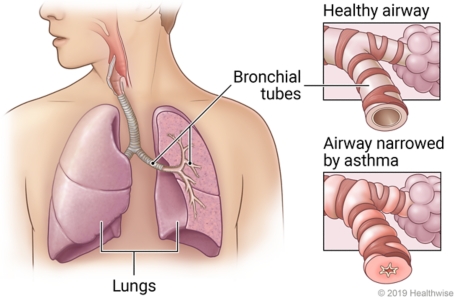 Bronichole