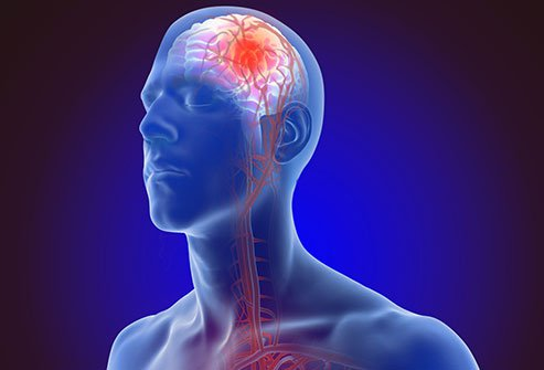 Non-Traumatic Acquired Brain Injury