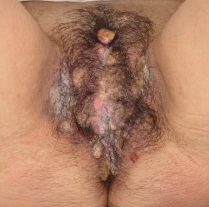 Vulvar Carcinoma