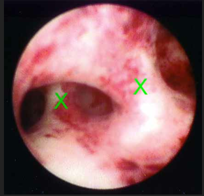 ASHERMAN SYNDROME