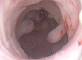 Endometrial polyp