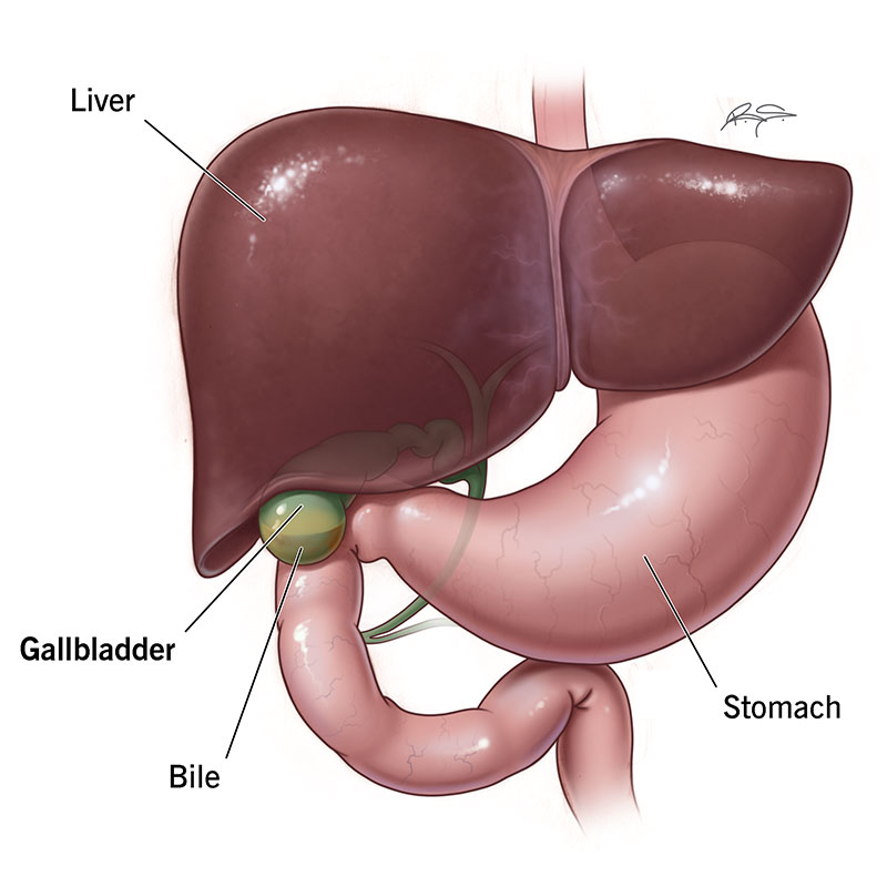 When the gallbladder does not empty, it might produce extremely concentrated bile.