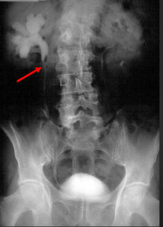 Urografía intravenosa: dilatación uretero-pielo calicilar derecha (flecha) por obstrucción en uréter proximal derecha.