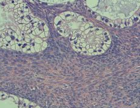 Surface Epithelial tumors