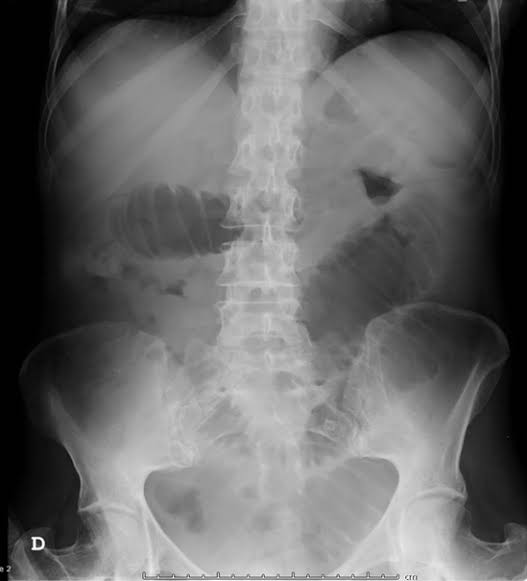 Proyección PA de abdomen en decúbito prono