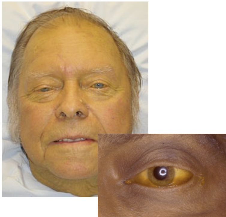 Virale:
Les hépatites virales sont nombreuses: A,B,C,D,E,
non-A, non-B, Herpes virus (CMV, Epstein-Barr,...).
- Phase préicté
