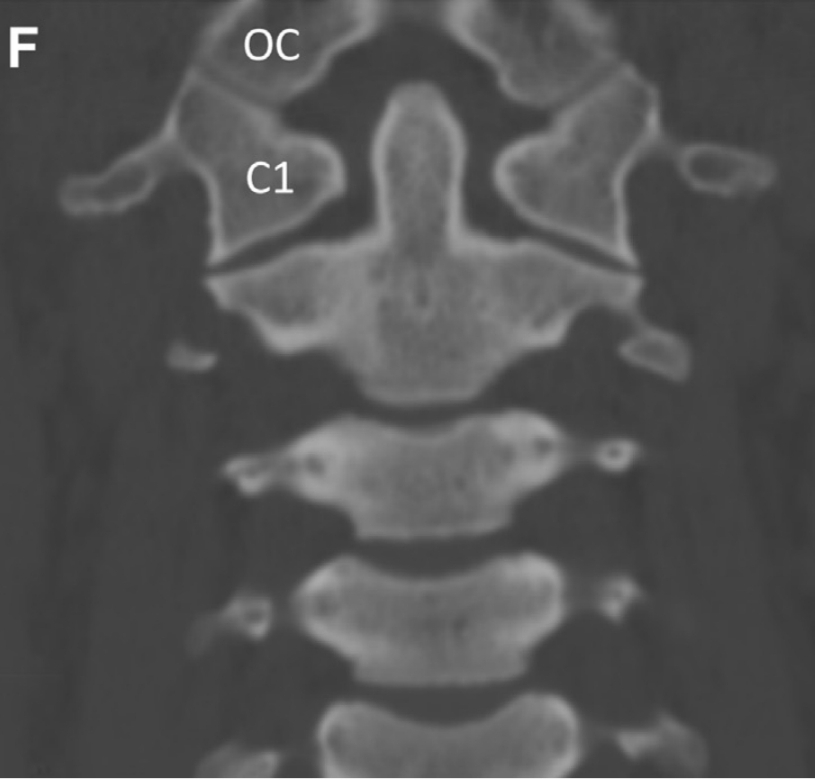Coronal
suma espacios
entre odontoides-C1
⬇️ 7 mm