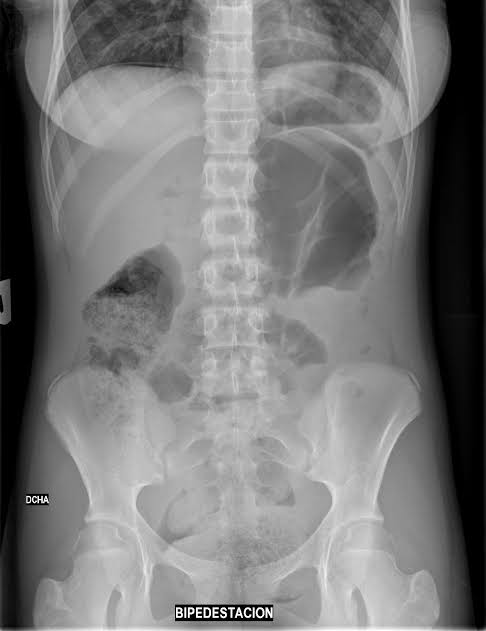 Proyección anteroposterior (AP) de abdomen en bipedestación