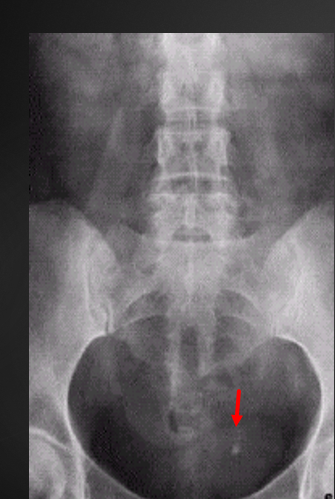 RX