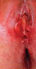 Extramamary Paget Disease