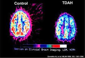 Neuroimagen TDAH