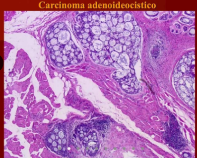 carcinoma adenoideocistico