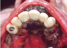 Melanoma