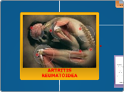 ARTRITIS REUMATOIDEA - Mapa Mental
