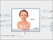 VARICELA - Mapa Mental